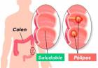 Cáncer de Colon: la prevención es fundamental