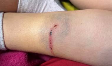 Solo una de cada cinco personas que es mordida por un perro acude a centros de salud