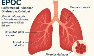 EPOC - Detectar a tiempo una enfermedad que puede avanzar en silencio