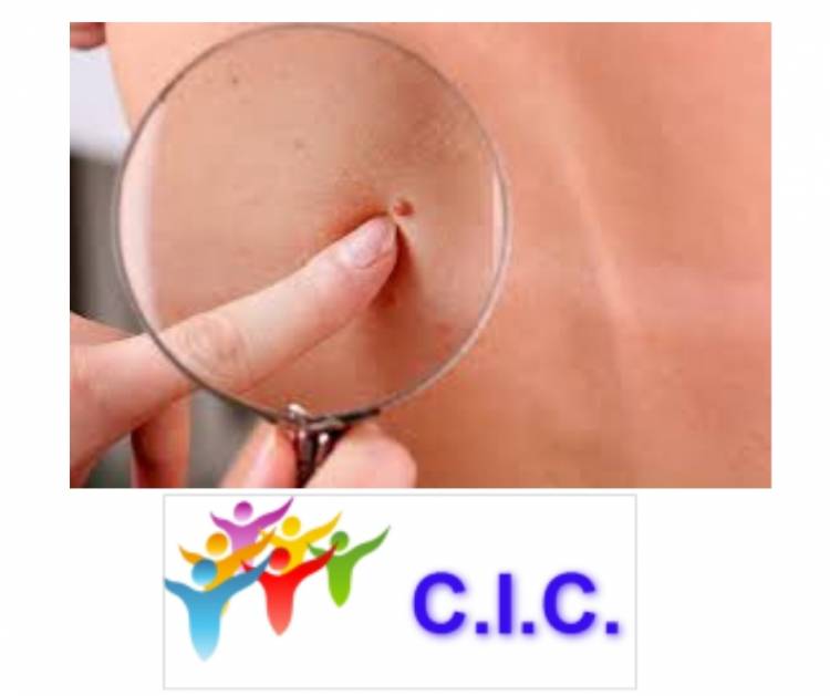 Cáncer de piel: Se puede y debe prevenir
