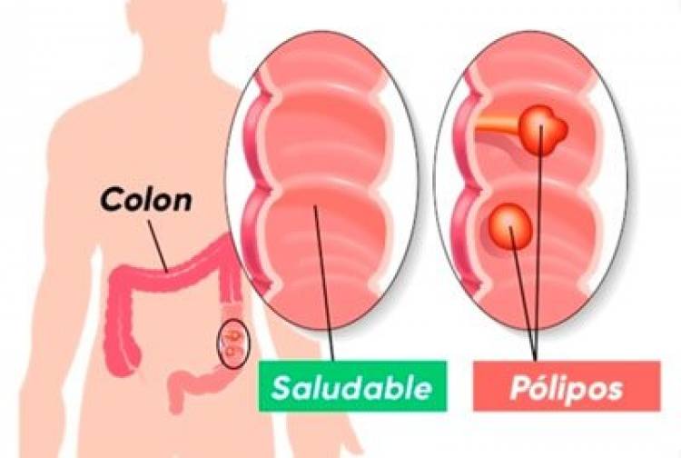 Cáncer de Colon: la prevención es fundamental