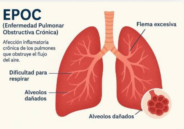 EPOC - Detectar a tiempo una enfermedad que puede avanzar en silencio